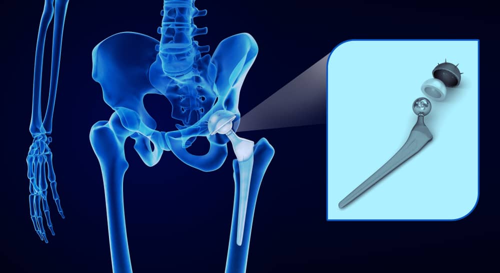 Physiotherapy before a hip replacement