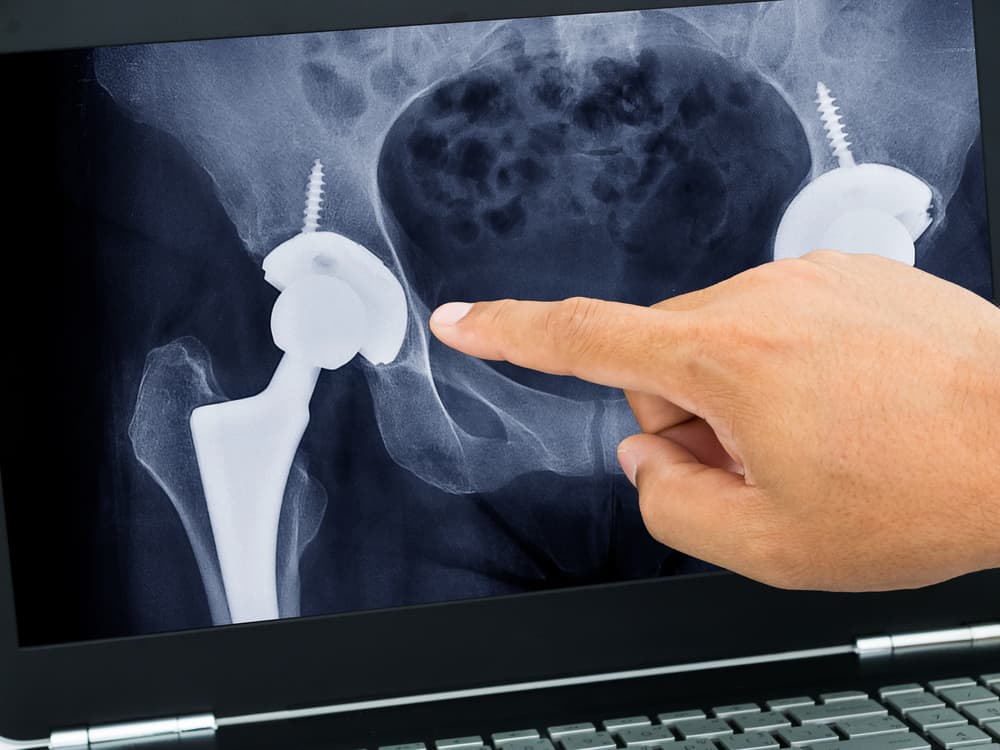 hip replacement after care