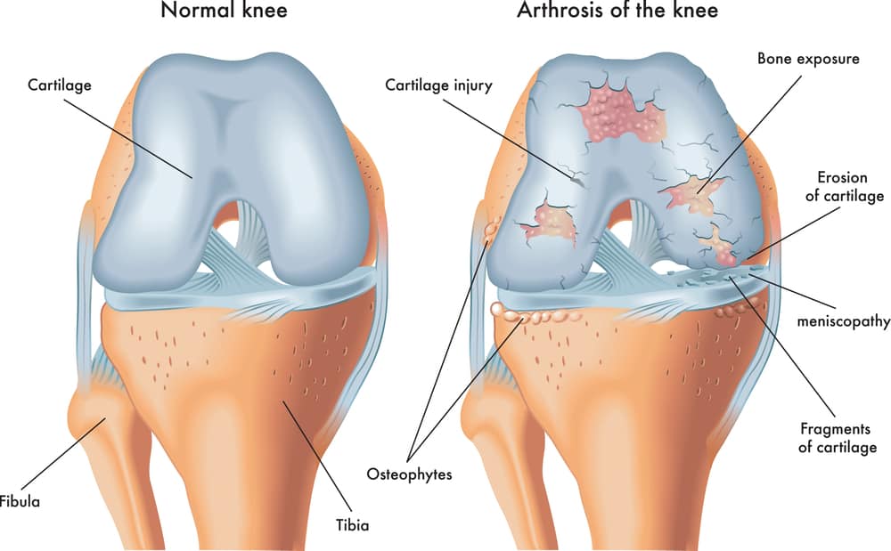 All the Details to Know About the Physiotherapy for Knee