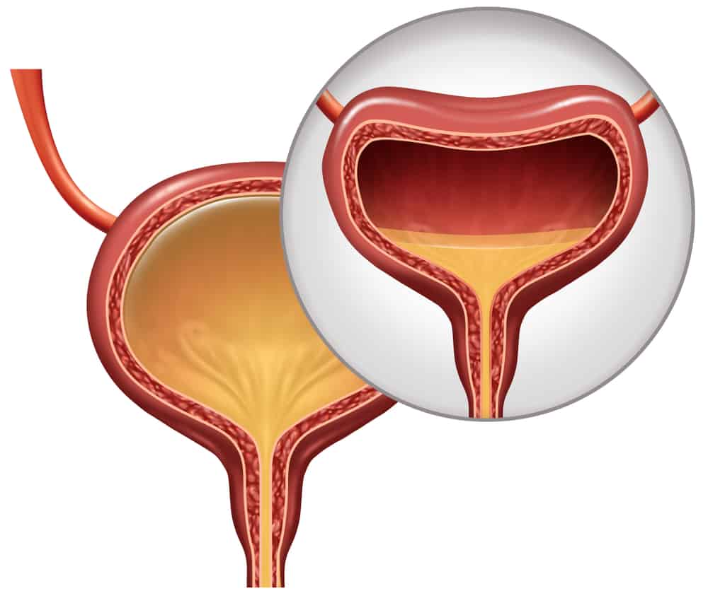Women's Urinary Incontinence