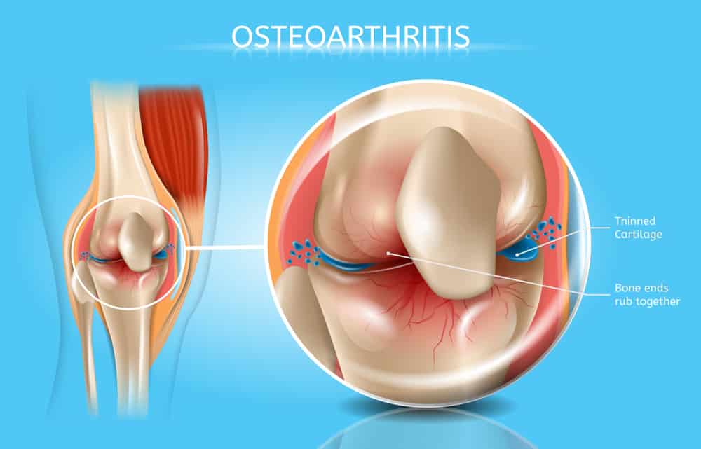 Physiotherapy Techniques For Osteoarthritis Treatment