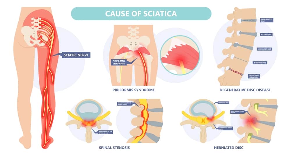 The Cause Of Sciatica