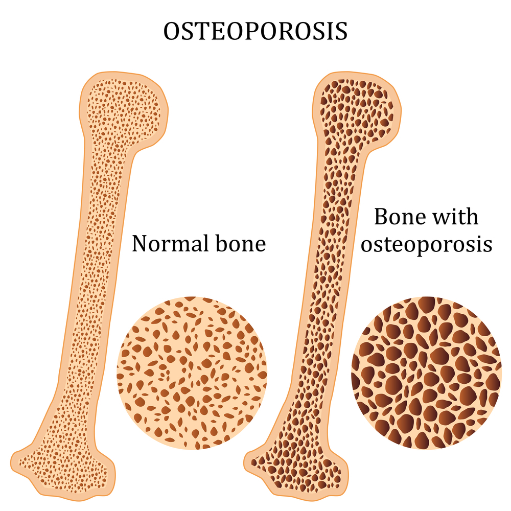 What Are 5 Symptoms of Osteoporosis?