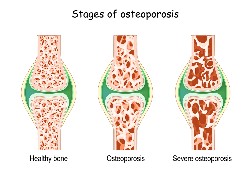 Osteoporosis stages