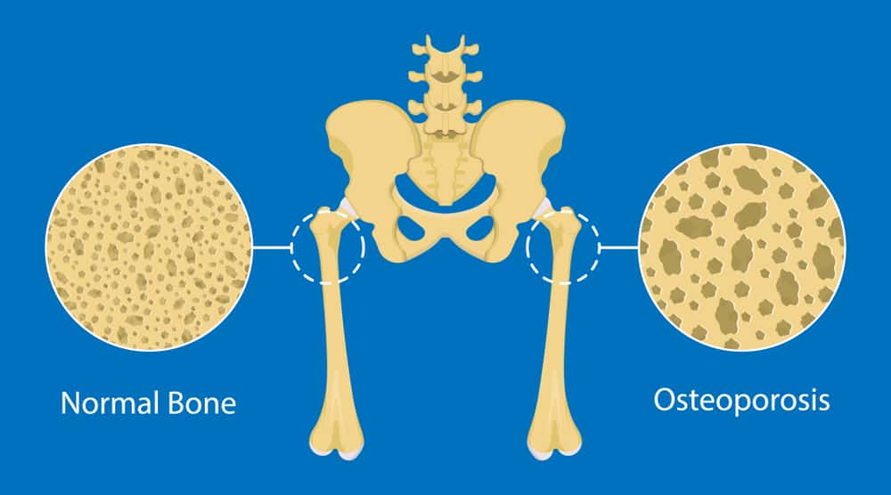  menopausal & osteoporosis Osteoporosis 