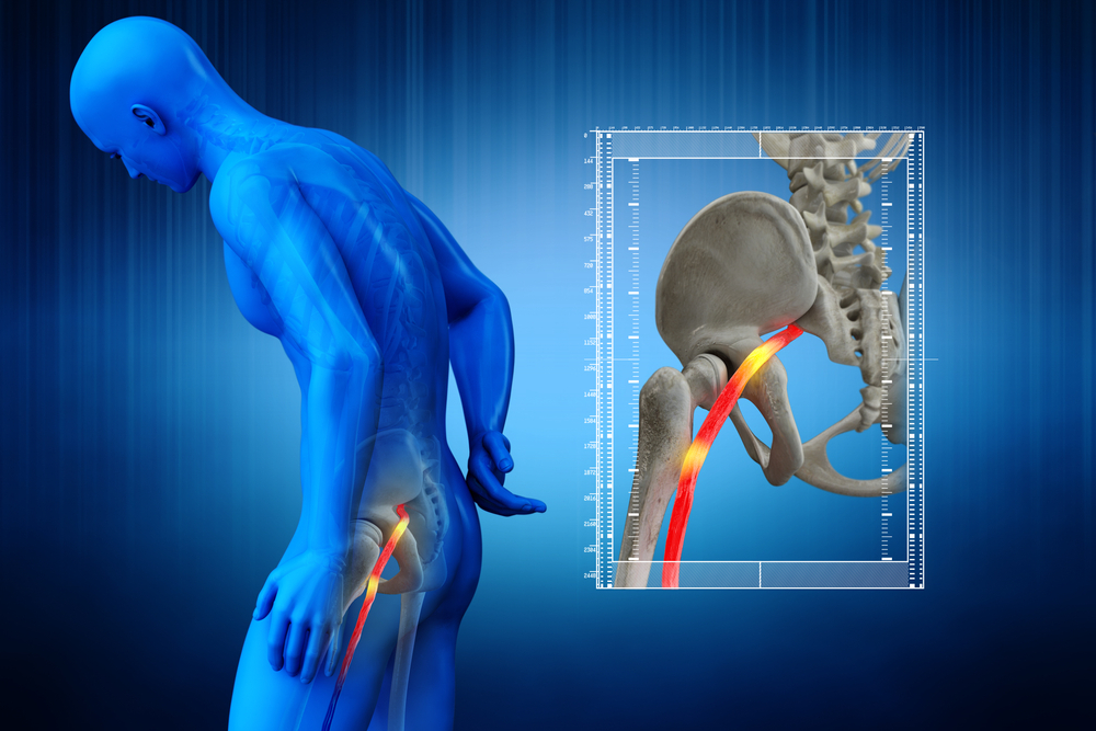 Physical Therapy to Treat Sciatica